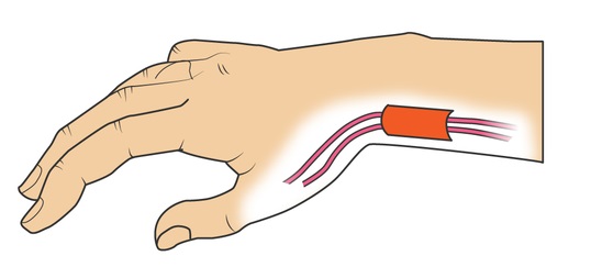 ドゥ・ケルバン病